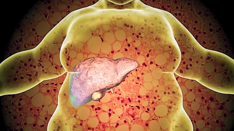 Fatty Liver