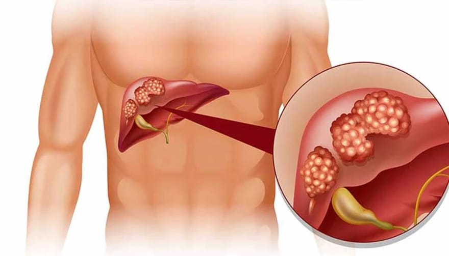 Liver Pathologies / Cancer