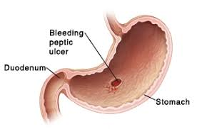 Ulcer Bleeding Mgt