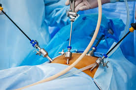 Laparoscopic surgery